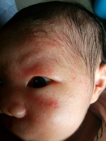 宝宝27天,脸上长了很多这种小红点,有些是白色