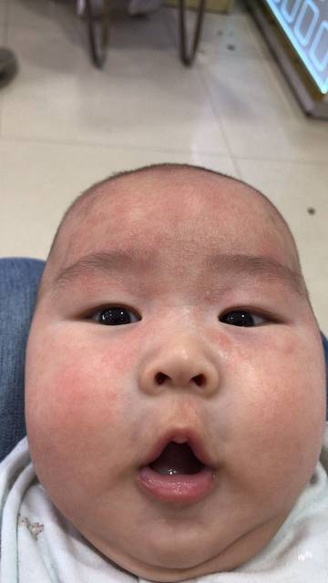 解决湿疹的办法