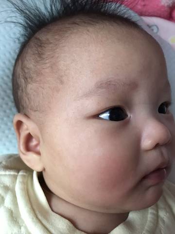 宝宝两个半月,右眼角外边有个小洞,从出生就有