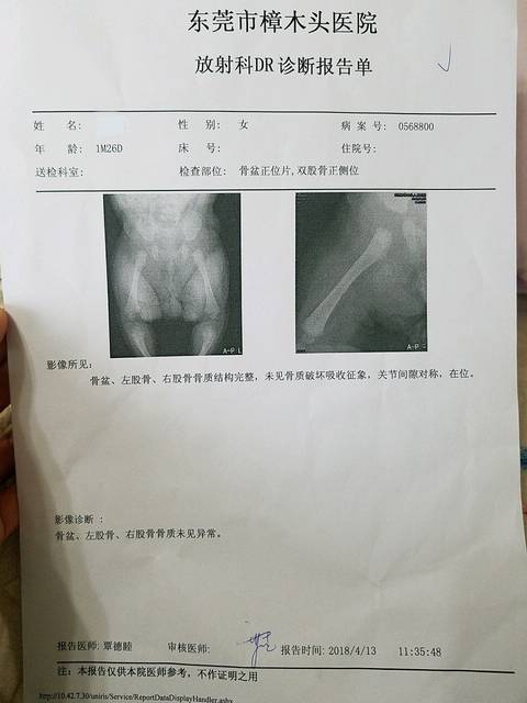 【新手报到】大腿纹不对称