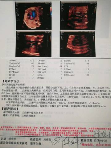 孕26周胎儿心脏超声显示三尖瓣中度关闭不全