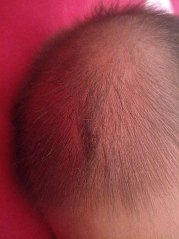 宝宝六个多月,发现宝宝头上有一撮头发特别黑