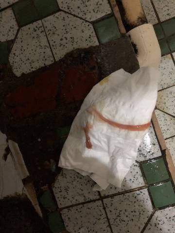 孕38周5天出现褐色分泌物,是怎么回事?肚子疼