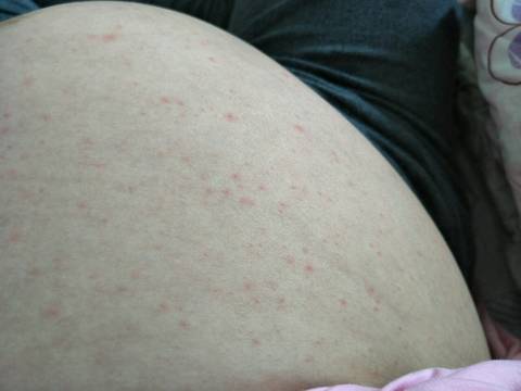 孕后期了肚子上突然长了好多小红点,还痒,有知道是什么原因的吗