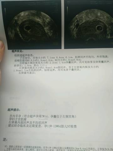 5.5号彩超偏左侧宫角,没管道胎芽,5.16彩超还偏三维胎心侧视图绘制图片