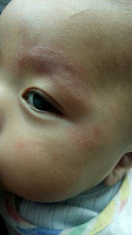 3个月宝宝脸上起密密麻麻的小疙瘩,眉毛他一直