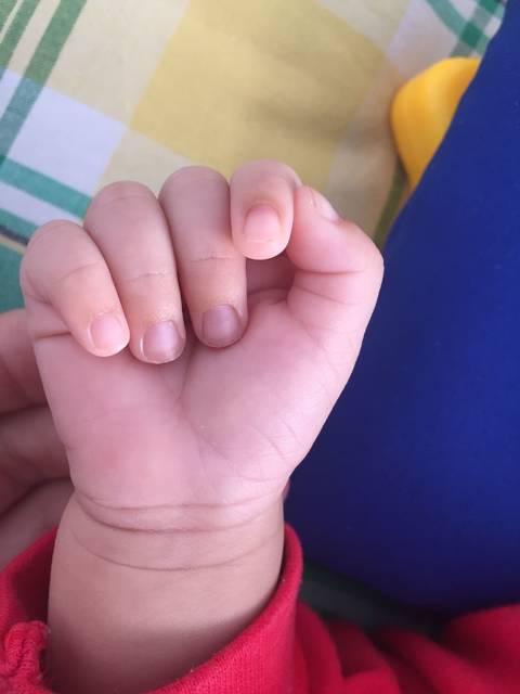 50天的宝宝手指甲边缘发黄怎么回事?
