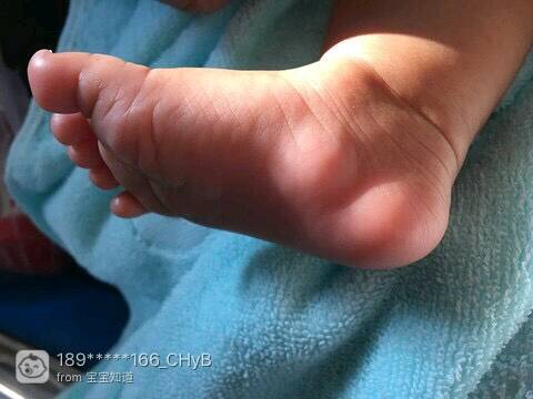宝宝5个月今天突然发现脚掌内侧靠脚后跟位置有对称突出疙瘩,有点红