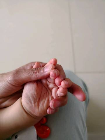 宝宝左手中指是不是真菌感染,越来越严重了,指