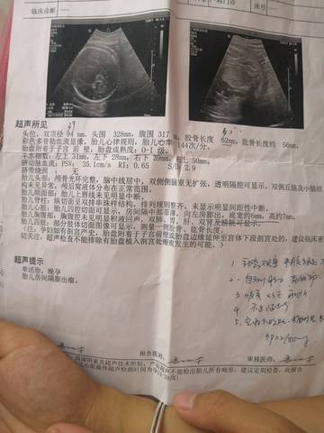 36+4查出胎儿房间隔膨出瘤,医生说需要动手术