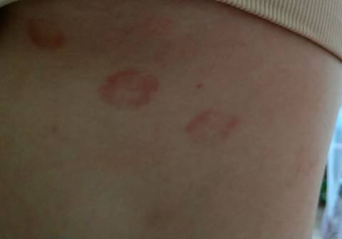 我现在还不到13周,在左胸下面长了四个硬币大小的红斑