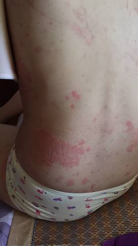 有没有出月子泡药浴，得急性荨麻疹的，你们是怎么好的?我的一天比一天厉害了，打脱敏第三天了还没好