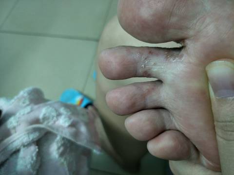 孕妇手脚长水泡,到底是脚气手气,还是湿疹?去