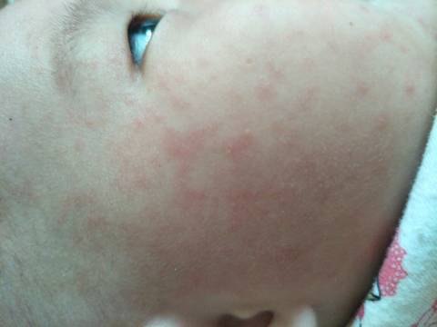 六个月宝宝发高烧退后出红疹,不知道是不是红