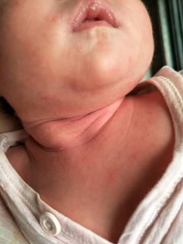 宝宝现在21天,满脸和脖子都长红疹痘痘,不知道该怎么办?