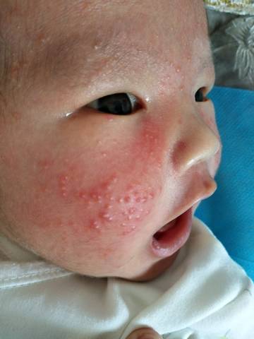宝宝21天了,脸上就是长痘痘,像青春痘一样,不知