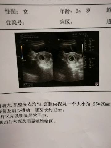 育儿问答 怀孕期 孕初期孕囊是椭圆形的是不是女孩?