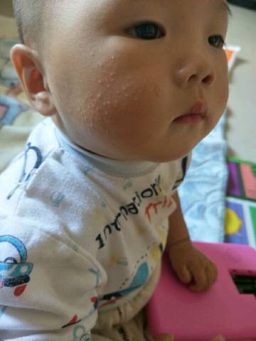 九个月宝宝脸上起了很多小颗粒 是不是湿疹啊