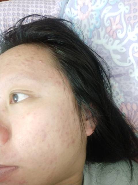 痘痘蔓延到下巴脖子和耳朵后面了