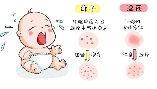 痱子与湿疹的区别是什么?不懂的看过来.