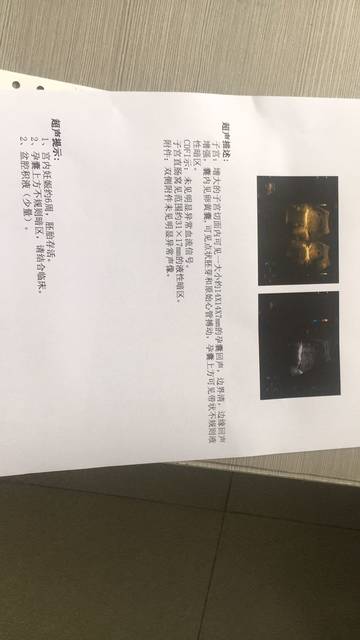 有b超有盆腔积液的吗?