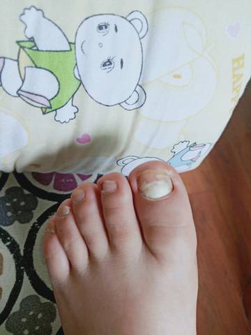 孕期脚趾甲变白是怎么回事呀?有什么方法可以