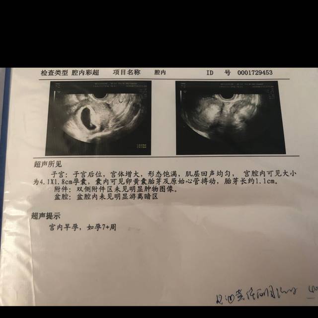 孕7周彩超胎心胎芽。但是孕酮13.2,4周孕酮18