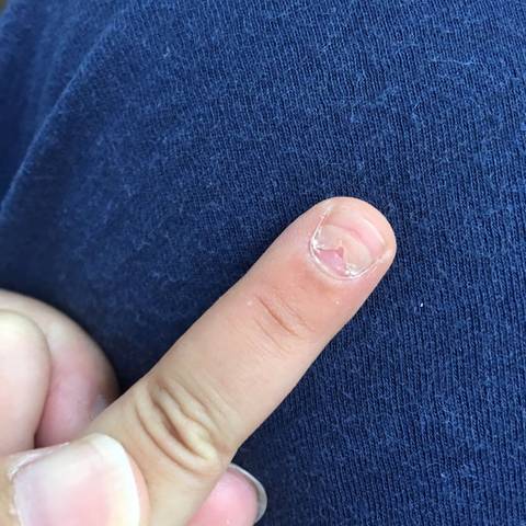 娃三岁多,最近左手的中指和大拇指出现以下情