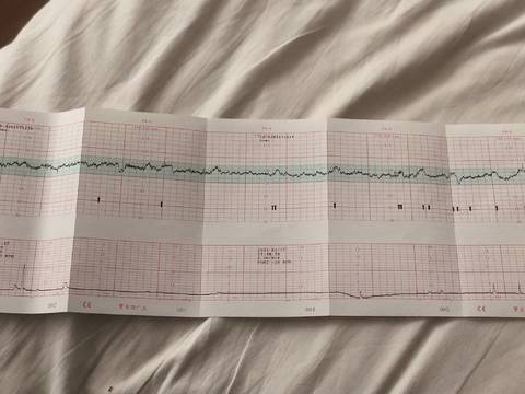 谁能帮忙看看,胎心监护是否正常,怀孕35周2 !谢谢