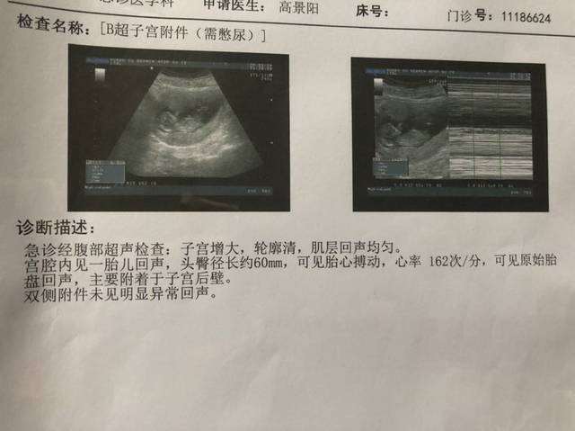 怀孕12周 掉出大血块