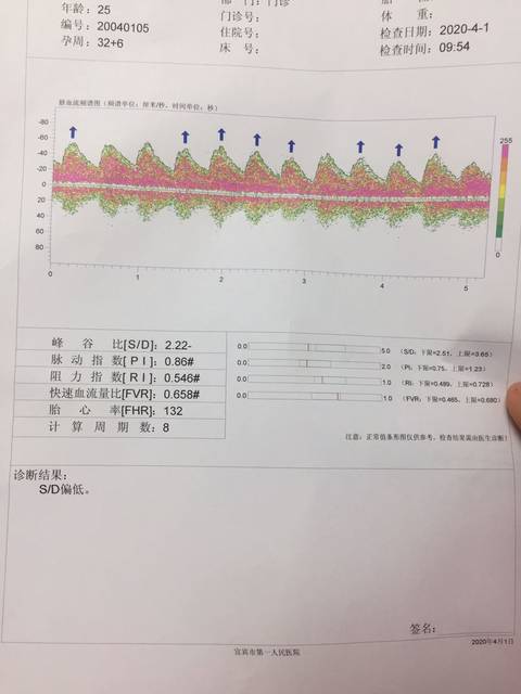 今天做了脐血流检查,结果sd偏低,是不是不正常啊,好担心宝宝