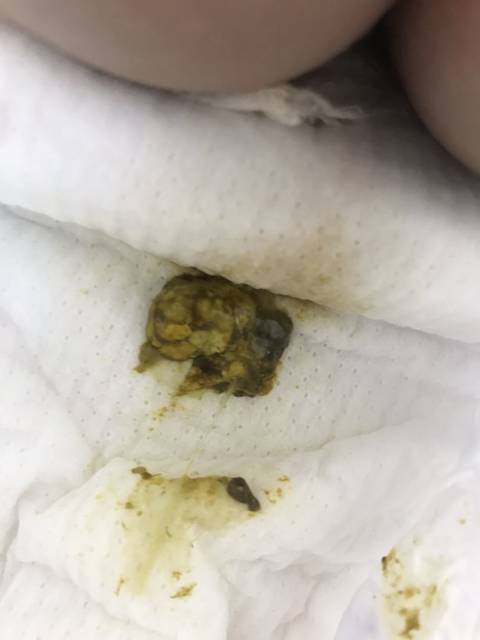 轮状病毒性腹泻_我家崽崽28号拉肚,拉的很稀,大便去时