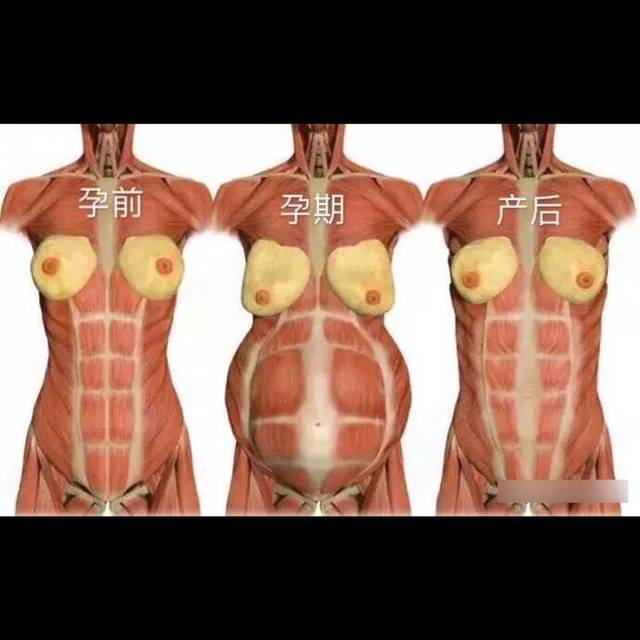 小心腹直肌分离让你变成