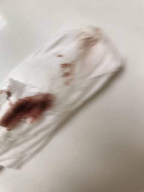 55天见褐色分泌物