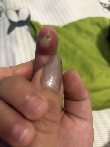 宝宝15个月, 四天前手指度上起个硬硬黑点, 今日突然化脓了.
