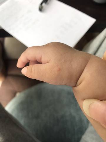 宝宝手上长了个小痘痘,这个是什么呢?
