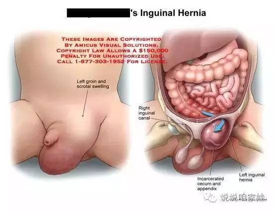 宝宝哭太多会得疝气吗?关于婴儿疝气的那些闹心事儿