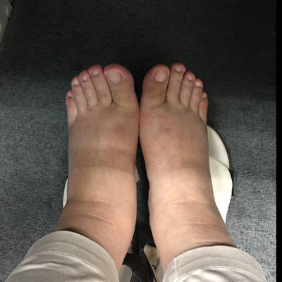 孕28 ,血压不高,糖筛已通过,脚肿成这样,有办法破不?