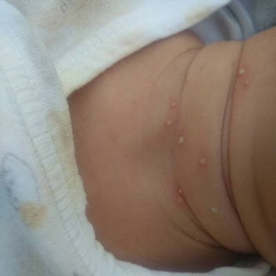 宝宝脓包疹的图片图片