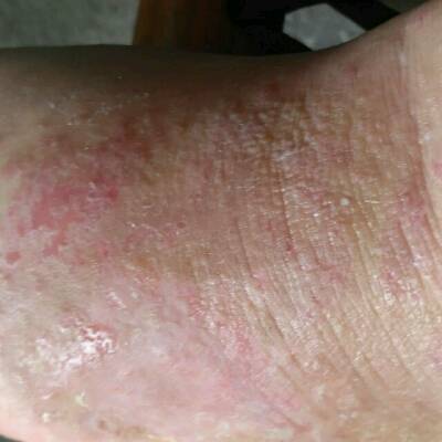 现在怀孕四个月,脚背上密密麻麻起来一层小水泡,非常严重,以前没有