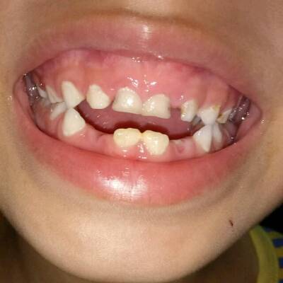 我儿子牙齿好小又稀,六岁换牙又是小米牙,我要怎麼办,要吃钙吗