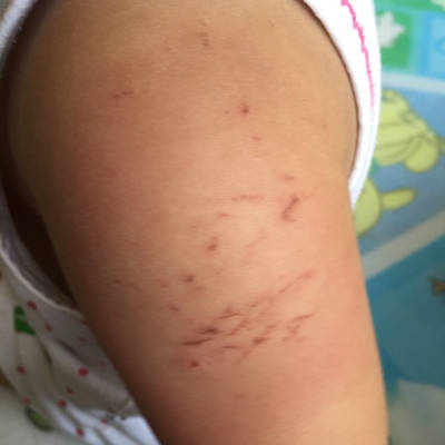 18个半月宝宝打完预防针洗完澡后 打针部分出现红肿现象并且痒 怎麼