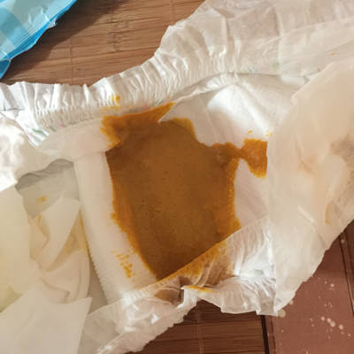 宝宝便秘拉这样的粑粑.