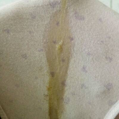 宫颈微波排黄水图片图片