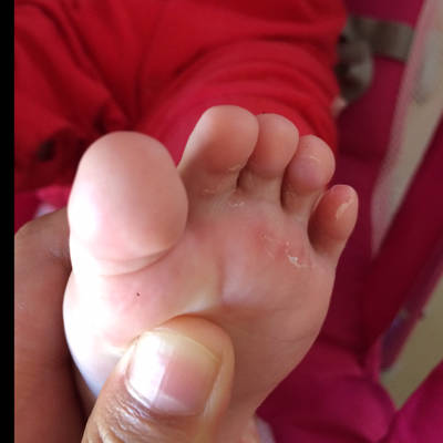 我宝宝六个月了,脚底有水泡,去医院检查说是脚气,怎麼办?