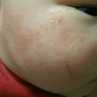 宝宝这两天脸上出这种一片一片的小红痘痘是什麼原因啊?