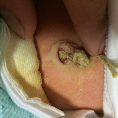 宝宝出生7天了肚脐眼好像化脓了怎麼办