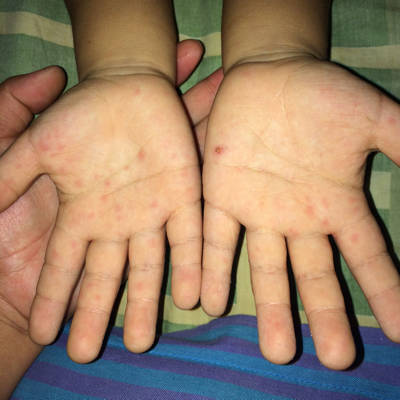 三岁宝宝手掌内红斑图片