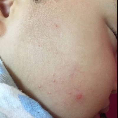 宝宝脸上最近长了些这个,摸上去毛毛的,是什麼呢,要不要紧啊