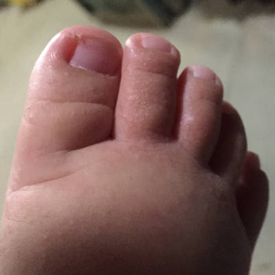 宝宝三个月了,发现脚气了怎麼办?